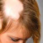 Blog-Exciplex-Alopecia
