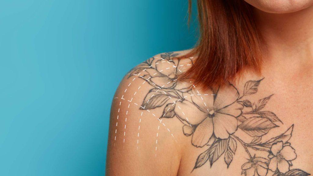 Laser Hair Removal with Tattoos