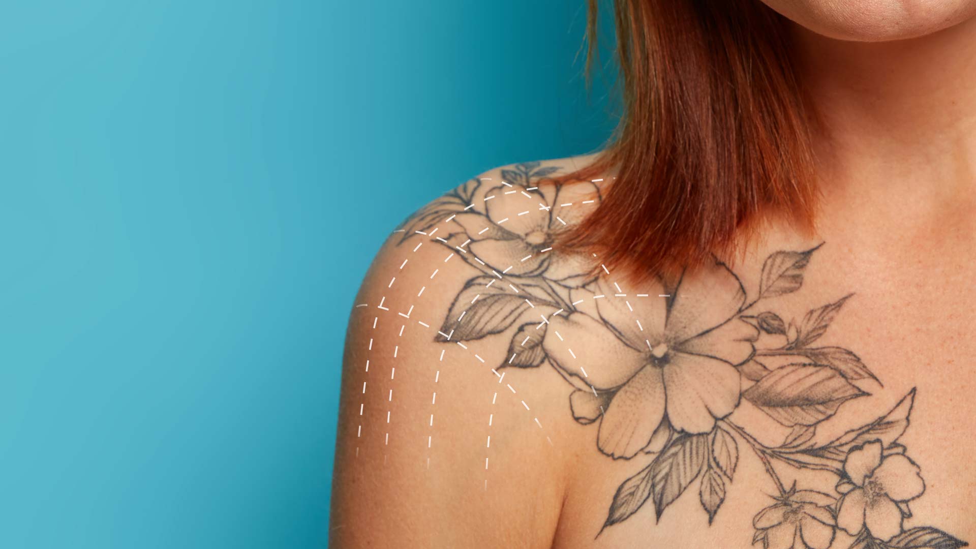 Laser-Tattoo-Removal-Body