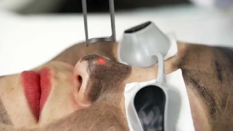 Carbon-Laser-Facial