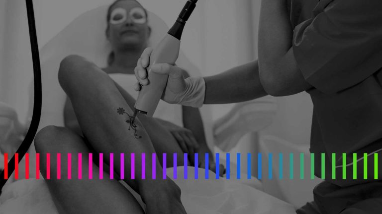 Tattoo-Laser-Technology